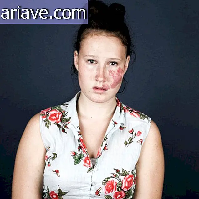 This essay with people who have birthmarks will move you