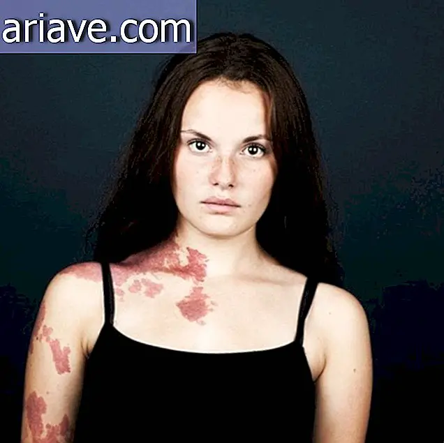 This essay with people who have birthmarks will move you