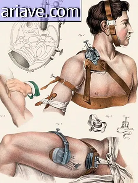 Impressionante! Vedi le illustrazioni degli interventi chirurgici del XIX secolo