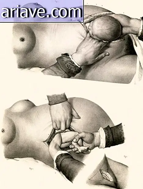 Impressionante! Vedi le illustrazioni degli interventi chirurgici del XIX secolo