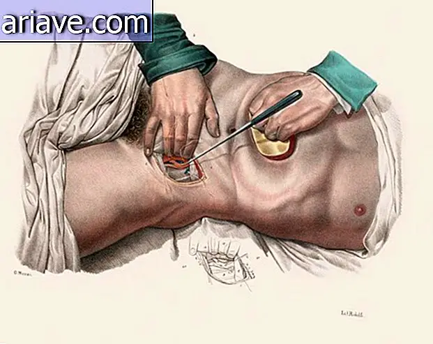 Super! Glej ilustracije operacij 19. stoletja