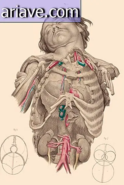 Super! Glej ilustracije operacij 19. stoletja