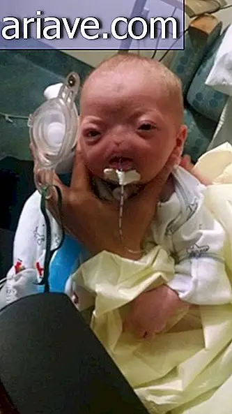 La nascita di un bambino senza naso tocca gli utenti di Internet in tutto il mondo
