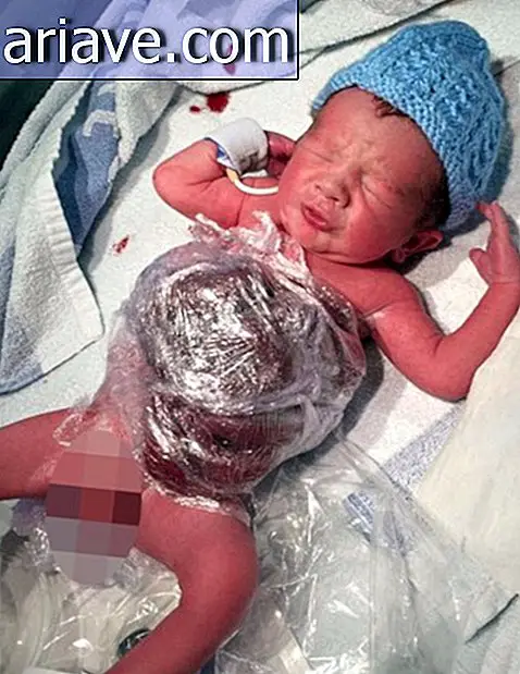 Milagro de la medicina: el bebé sobrevive incluso naciendo con tripa