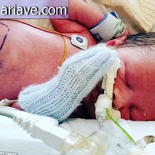 Tıbbi Mucize: Bebek Gut Çıkarak Doğmaktan Bile Kurtulur