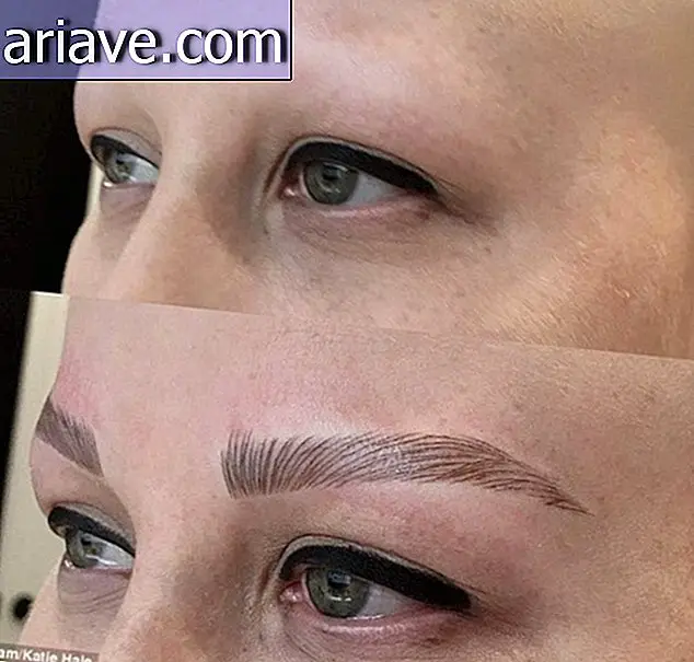 After losing all body hair, young woman celebrates new eyebrows