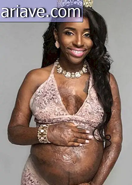 Mujer sobreviviente de incendio muestra cicatrices en fotos de su embarazo