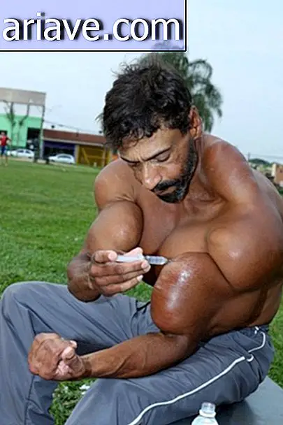 Ce Brésilien s’injecte de l’huile il y a 5 ans pour se muscler