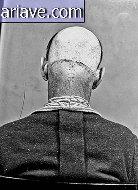 Kinh dị: Những hình ảnh cũ đáng sợ của bệnh nhân phẫu thuật não