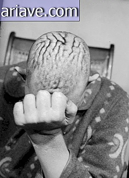 Horor: Menakutkan Foto-foto Lama Pasien Bedah Otak