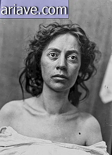 Horror: fotos antiguas y aterradoras de pacientes de cirugía cerebral
