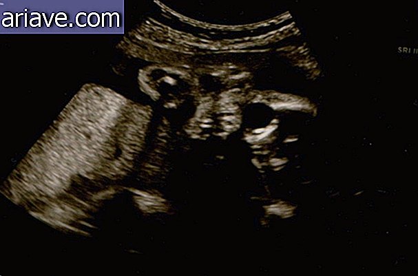 Atemorizante: estos ultrasonidos te harán pensar dos veces antes de tener hijos