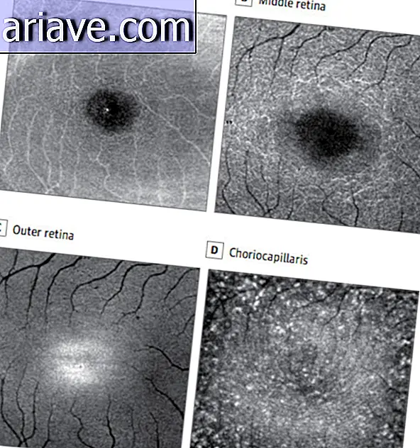 Lesioni alla retina
