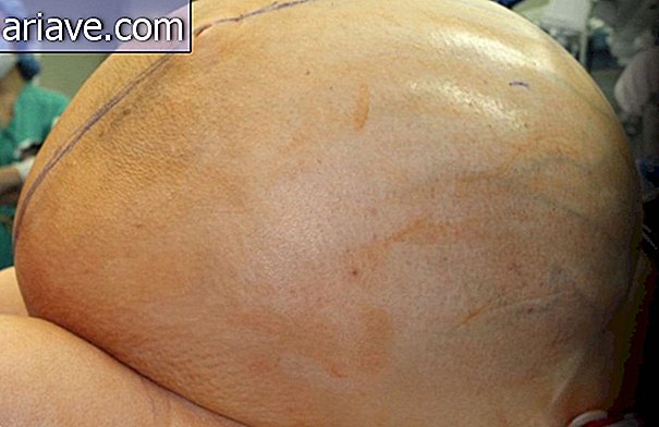 Kolossale ovariële tumor