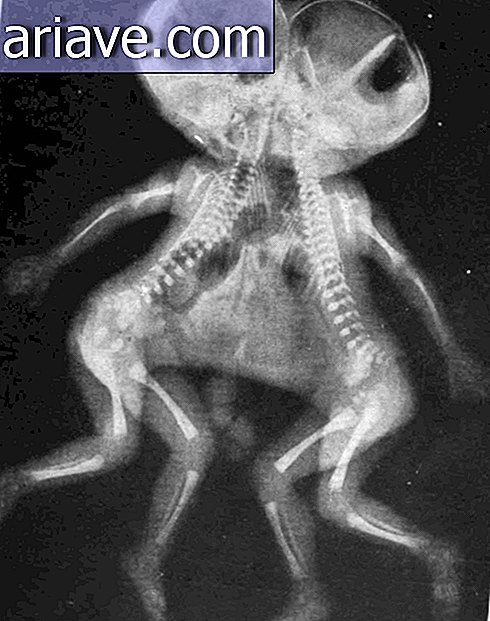 Radiografia gemella siamese